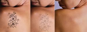 Picosure Tattoo Removal in Warrington