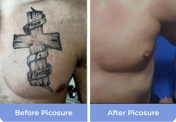 Will laser tattoo removal completely remove a tattoo? - Goodbye Tattoos