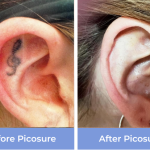 Picosure Tattoo Removal in Middlewich 