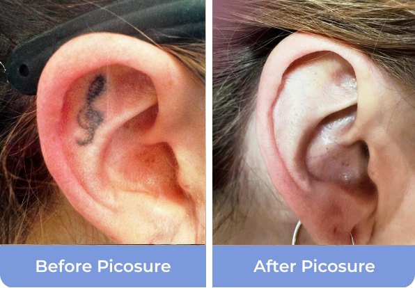 Picosure Tattoo Removal in Middlewich