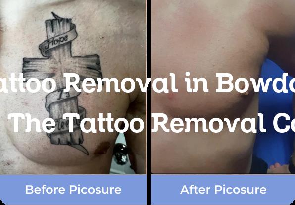 Tattoo Removal in Bowdon