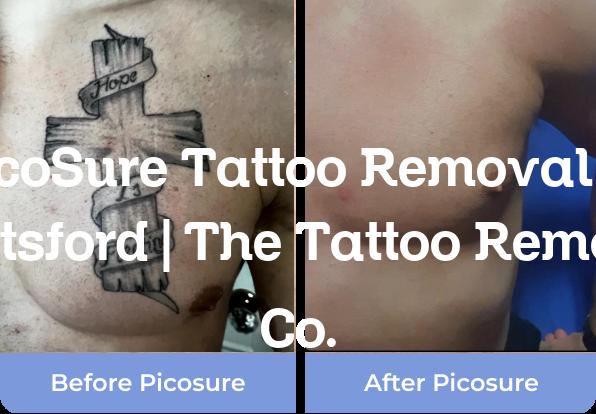 PicoSure tattoo removal Knutsford