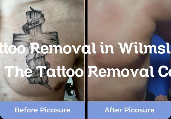 Tattoo Removal Wilmslow