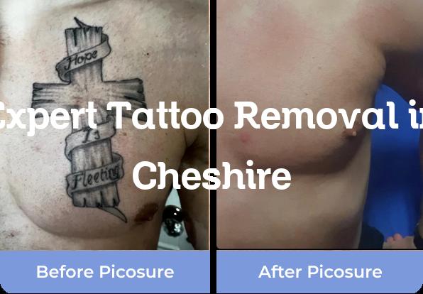 tattoo removal in Cheshire