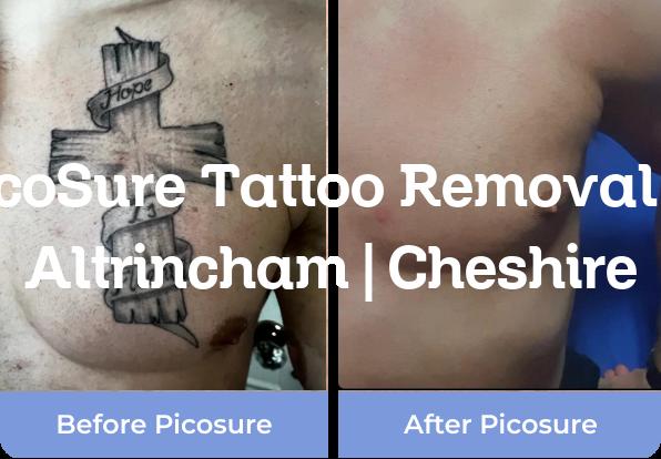 PicoSure tattoo removal Altrincham